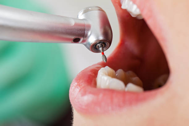 Best Emergency Tooth Extraction in Hamburg, IA